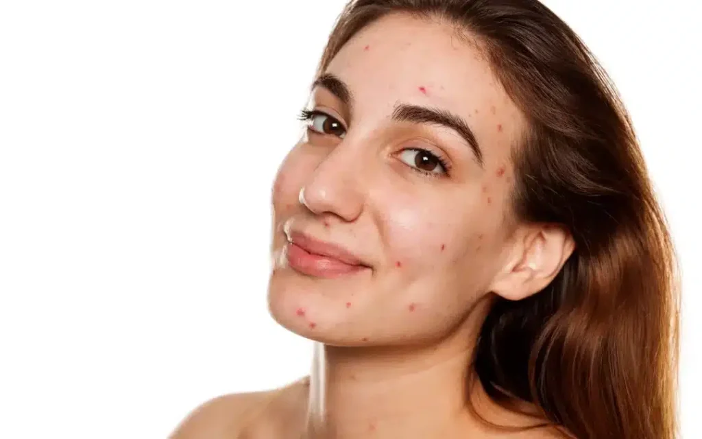 Dermal Fillers for Acne Scarring: Which Products Deliver the Best Results?